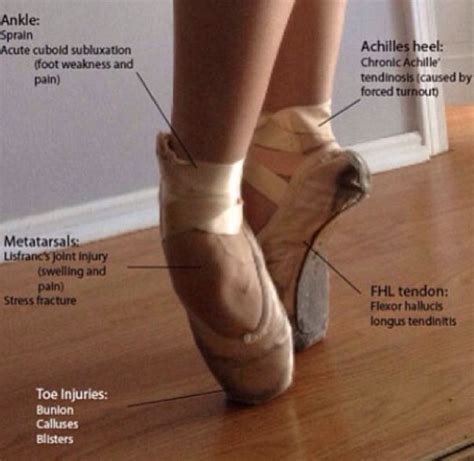 Common Dance Injuries From Pointe Shoes Dancers Feet Dance Life