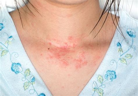 Guide To Allergic Skin Rashes