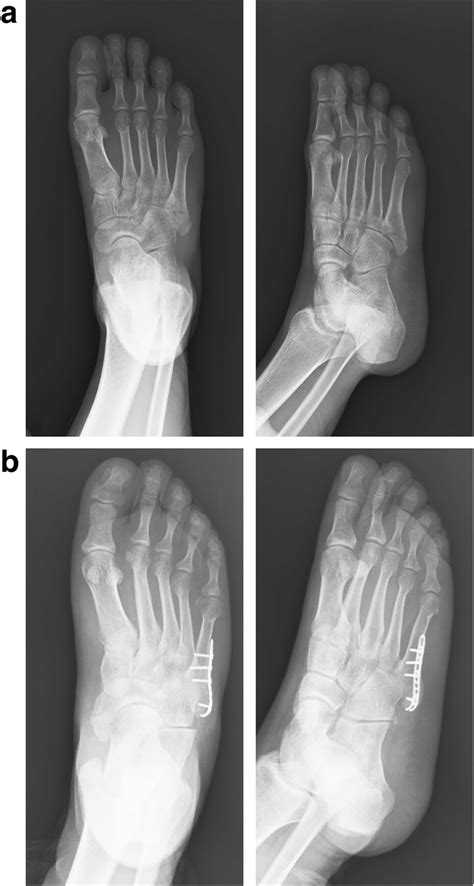 Pre A And Postoperative B Radiographs Of A Fifth Metatarsal Base