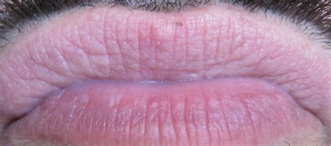 White Hard Bump On Inside Of Lip