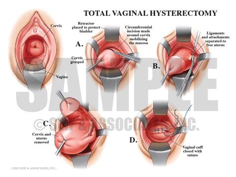 Vaginal Hysterectomy Female Reproductive System Pinterest Surgery