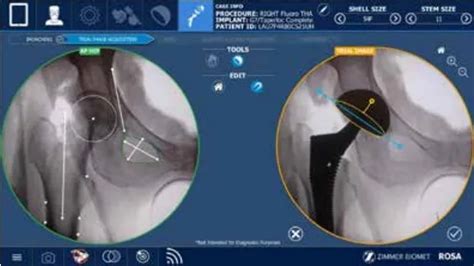 Launching Robotic Hip And Knee Replacements At The Honolulu Sports And