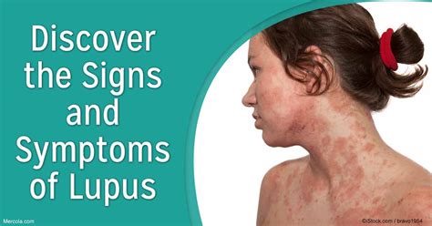 What Are The Signs And Symptoms Of Lupus