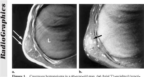 Figure 1 From Chest Wall Tumors Radiologic Findings And Pathologic