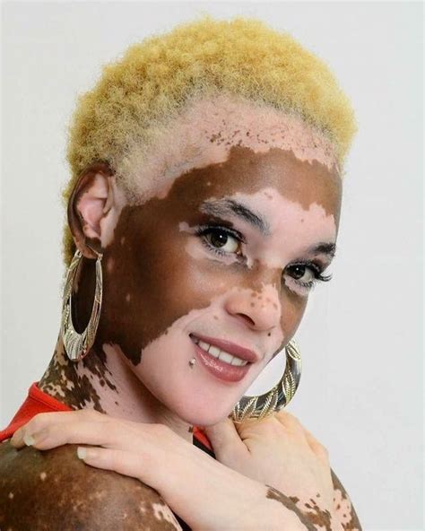 Pretty People Beautiful People Vitiligo Treatment Unique Faces Birthmark Interesting Faces