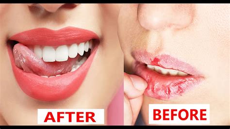 Cure Chapped Lips At Home 100 Effective Youtube