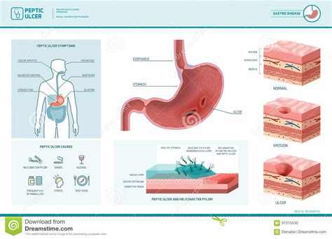 Infographic Maagzweer En Helicobacter Pylori Vector Illustratie Illustration Of Diagnose