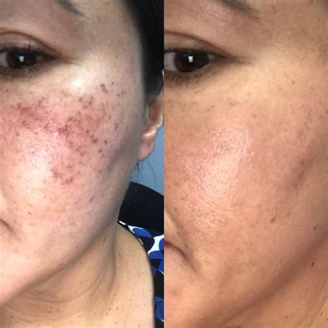 Acne Scar Treatment Microneedling With Prp Dermatologist Tarzana
