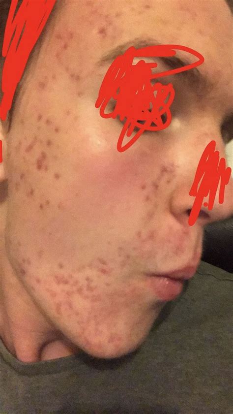 Help Me With Post Inflammatory Erythema And Other Post Acne Scars