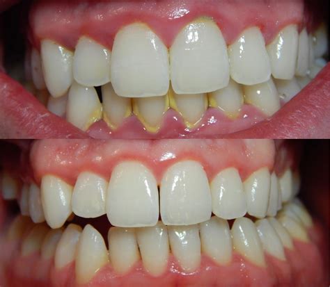 Dental Clinic 3d ¿qué Es La Gingivitis