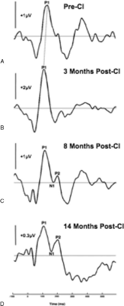 Developmental Trajectory Of Patients Caep Response In Her Right Ear