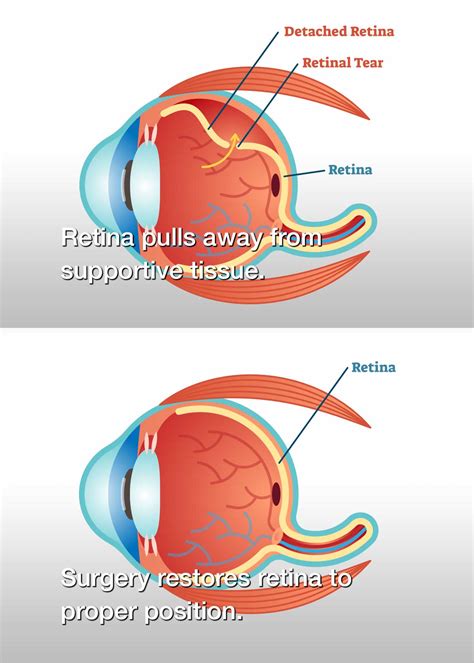 Retinal Detachment Surgery