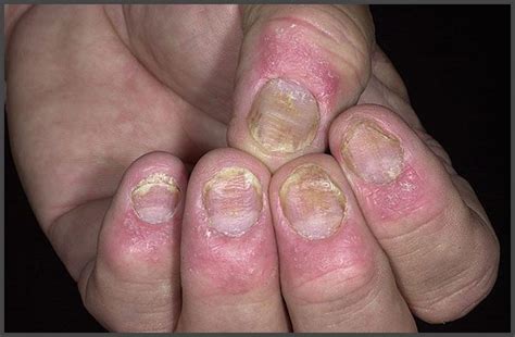 Finger Nails Psoriasis Pictures Psoriasis Expert