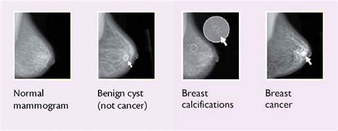 Breast Changes And Conditions Nci