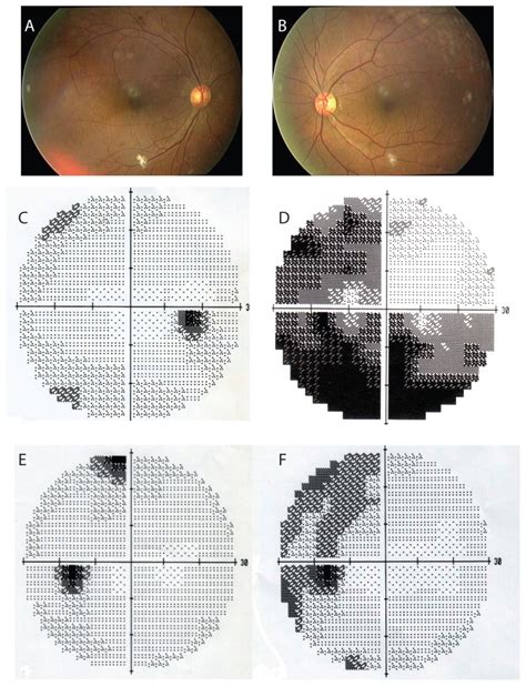 Fundus Photograph And Results Of Humphrey Static Perimetry A And B