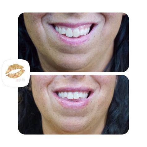 Lip Flip Before And After Gummy Smile Before And After Instagram