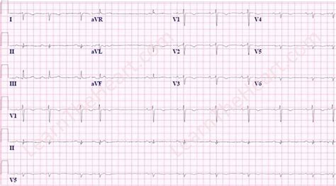 Dextrocardia Ecg Example 1 Learn The Heart