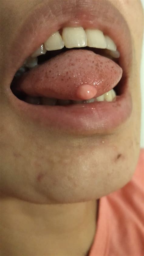 How Is A Tongue Polyp Removed And Who Should I Go To Photo Human