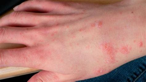 Scabies Dermatology Conditions And Treatments