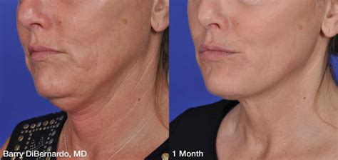Skin Tightening With Thermitight Weston Phanor Calle Md