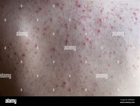 Skin Red Spots Hi Res Stock Photography And Images Alamy