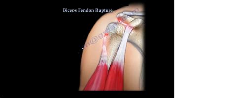 Proximal Biceps Tendon Rupture Orthopaedicprinciples