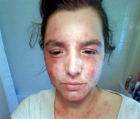 Woman Says Vaping Cbd Oil Has Cured Her Severe Eczema Metro