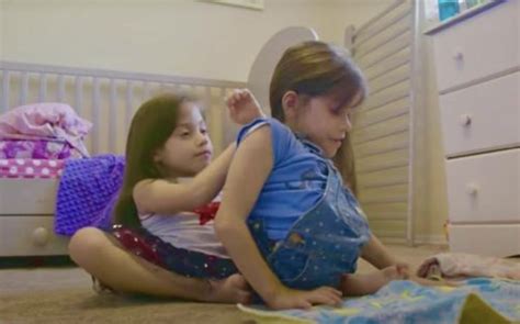 Conjoined Twins Separated At 2 Years Old Defy All The Odds And Celebrate Their 6th Birthdays