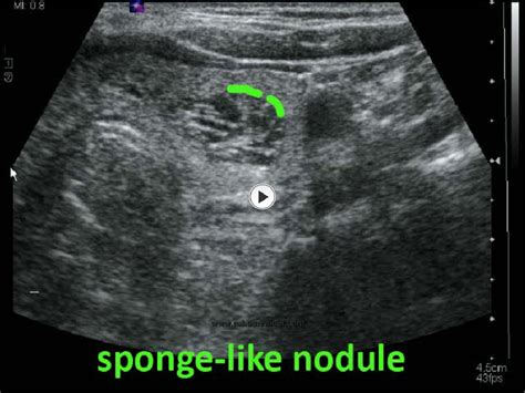 Figure 14 From Practical Approach To Thyroid Nodulesultrasound
