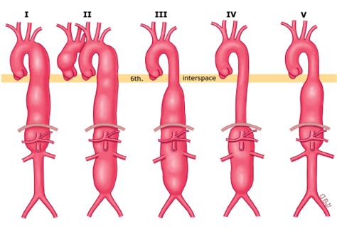 Thoracic Aortic Aneurysm Classification