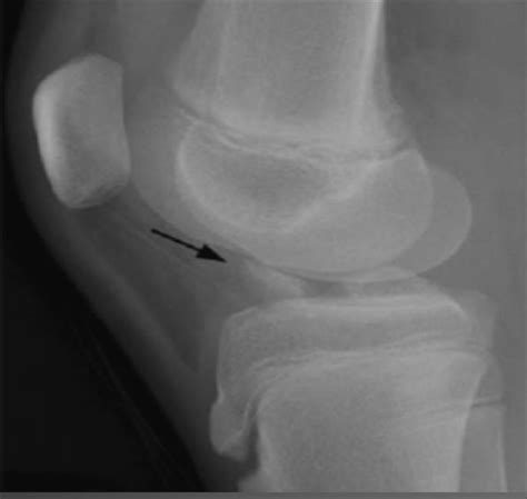 The Perfect Lateral X Ray To Diagnose Tibial Eminence Fracture