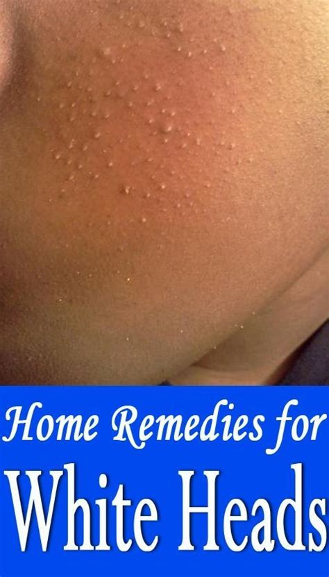 What Causes Whiteheads Home Remedies For Acne Acne Remedies Natural