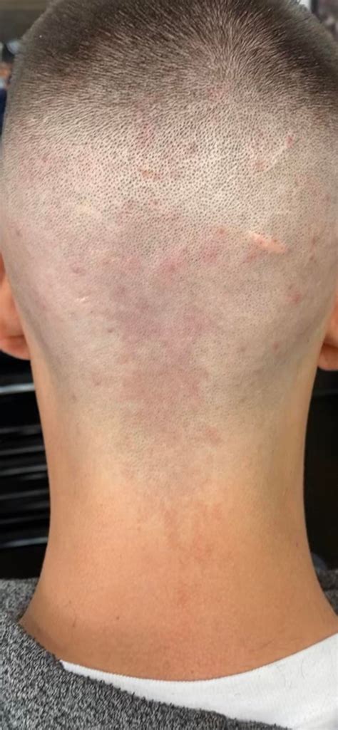 22m Redness In Back Of Head And Neck That Started 4 Months Ago And Acne
