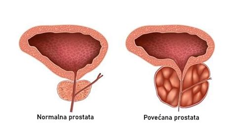 Povećana prostata Kako smanjiti volumen prostate