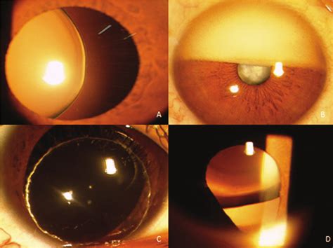 A Subluxated Cataract Zonules Can Be Visualized B Complicated