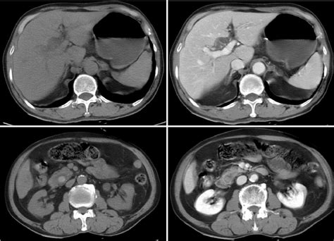 Abdominal Ct Scan It Demonstrates Dilated Intrahepatic Bile Duct And A