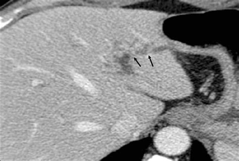 Contrast Enhanced Abdominal Ct Shows Focal Left Intrahepatic Duct
