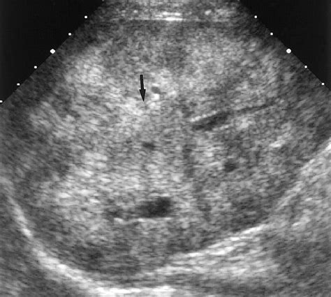 Fat Containing Lesions Of The Liver Radiologic Pathologic Correlation