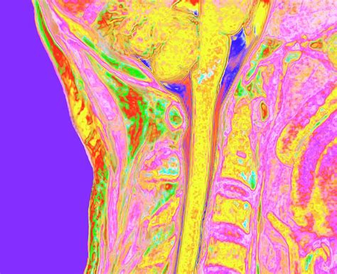 Upper Spinal Cord And Vertebrae Photograph By K H Fungscience Photo