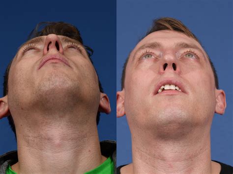 Rhinoplasty Before And After 13
