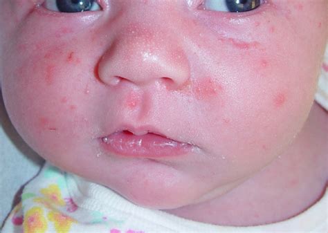 Neonatal Acne Acne Neonatal And Infantile The Clinical Advisor