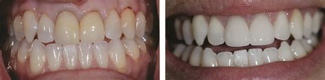 I had some brown stains between my four front teeth on both the bottom and the top. Teeth Stain Removal is Easier Thank You Think
