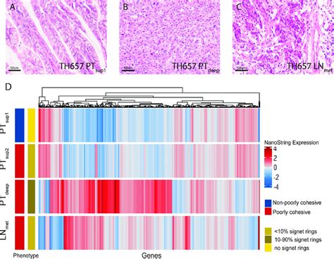 Phenotypical And Transcriptomic Heterogeneity In Gastric Cancer Th657