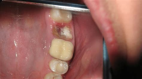 Cold Sensitivity After Wisdom Tooth Extraction Tooth Bantuanbpjs