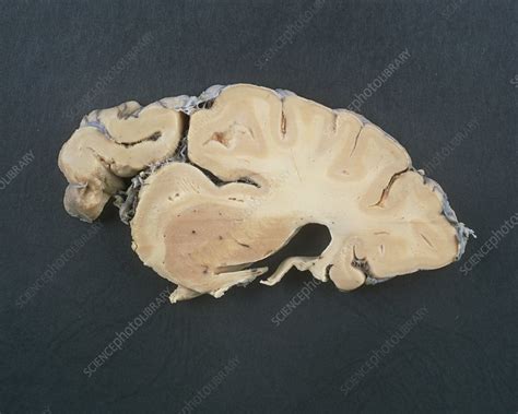 View Of A Slice Through A Healthy Human Brain Stock Image P3300269