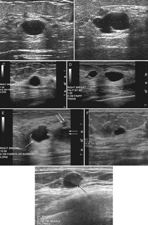 Breast Ultrasound Clinical Gate