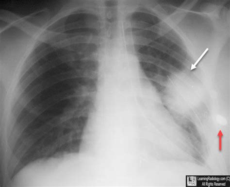 Learning Radiology Pulmonary Laceration Traumatic Pneumatocele