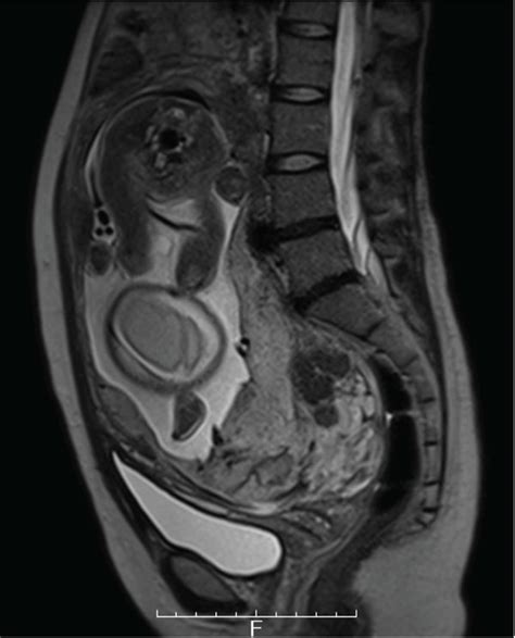Mri Findings Of Placenta Previa A Sagittal And B Axial Image