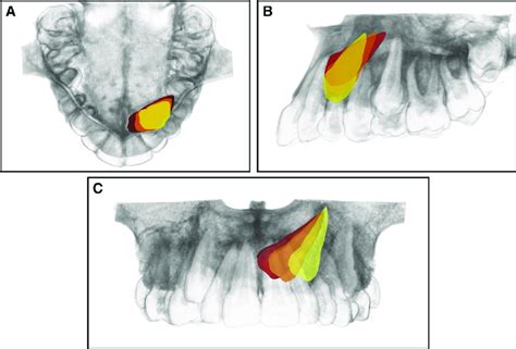 Different Impaction Severity Scenarios Graphic Representation Of The