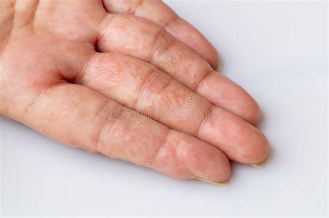 Close Up Atopic Dermatitis On Fingerad Also Known As Atopic Eczema